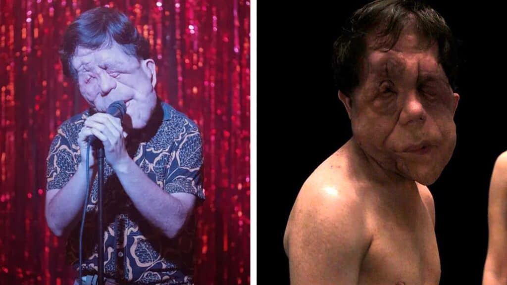 Un hombre diferente: ¿Quién es Adam Pearson, el hombre con desfiguración facial?