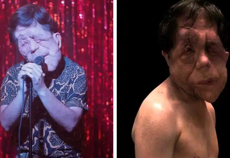 Un hombre diferente: ¿Quién es Adam Pearson, el hombre con desfiguración facial?